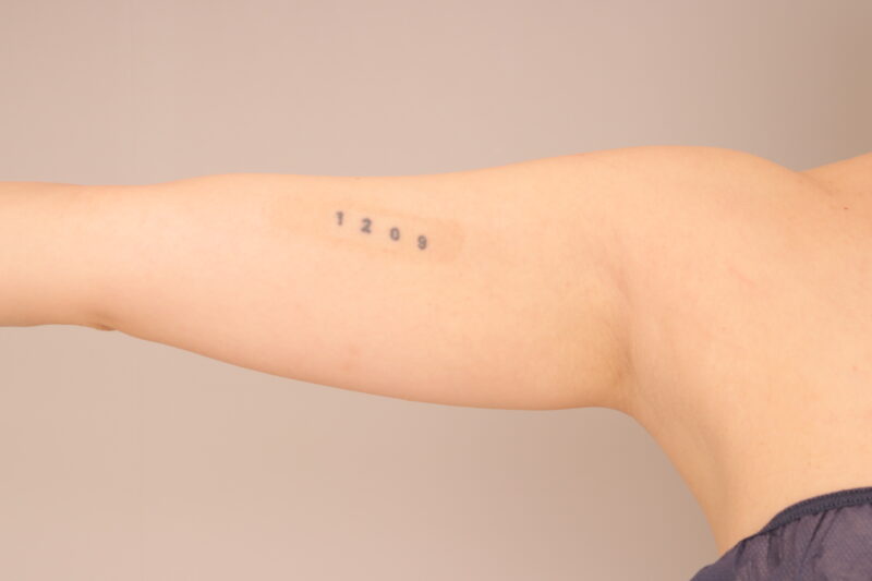 ベイザー脂肪吸引（半年経過：29）の術前写真