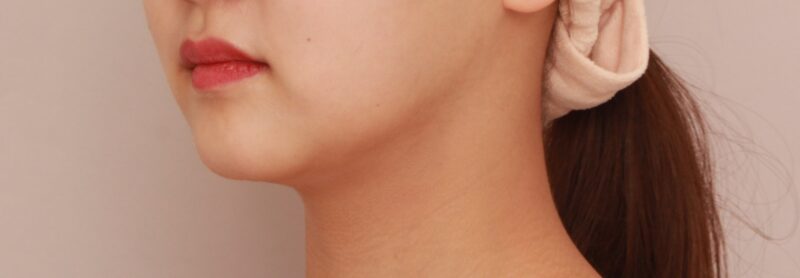 【頬+顎下】口横や顎下のもたつきをスッキリと!