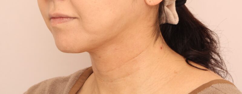 【頬+顎下】40代以降でも顔の脂肪吸引で変化が出せる・・?