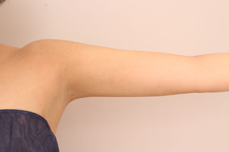 【上腕+肩】二の腕の脂肪吸引がおすすめのタイプとは・・?