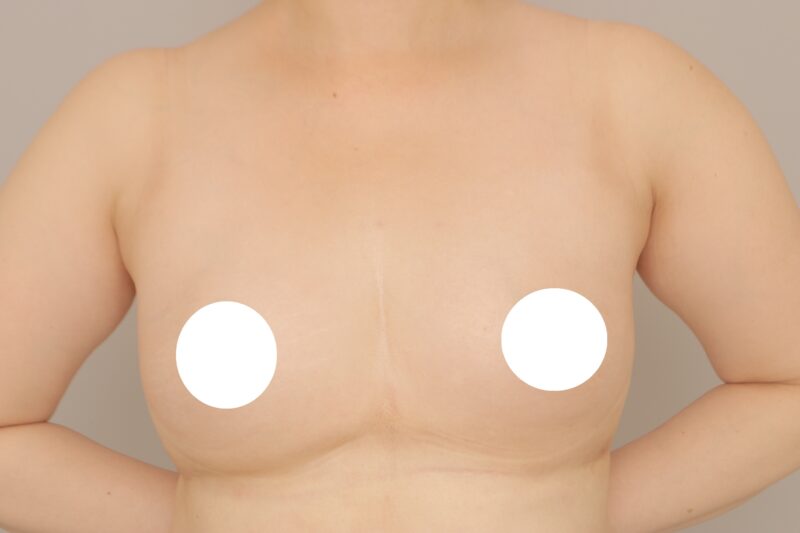 3ヶ月後(1回目)、42歳、BMI 25