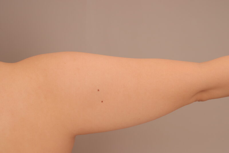 ベイザー脂肪吸引（半年経過：31）の術前写真