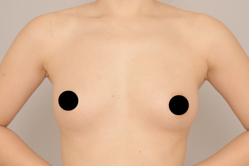 ベイザー脂肪吸引（3か月経過：38）の術後写真