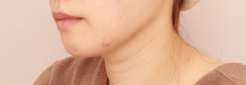 【頬＋顎下】元々すっきりとした輪郭の方もより明瞭なフェイスラインに！