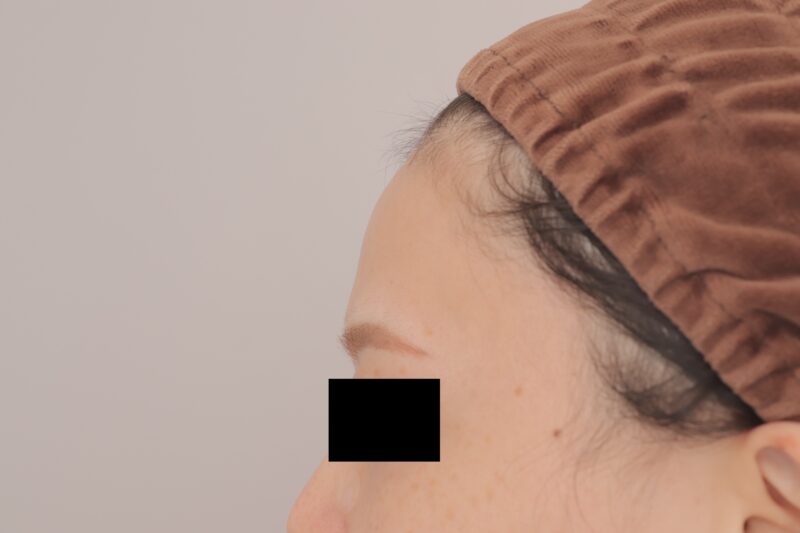 ベイザー脂肪吸引（3ヶ月経過：29）の術前写真