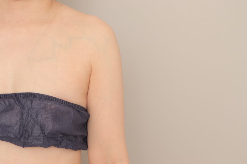 ベイザー脂肪吸引（3か月経過：49）の術後写真