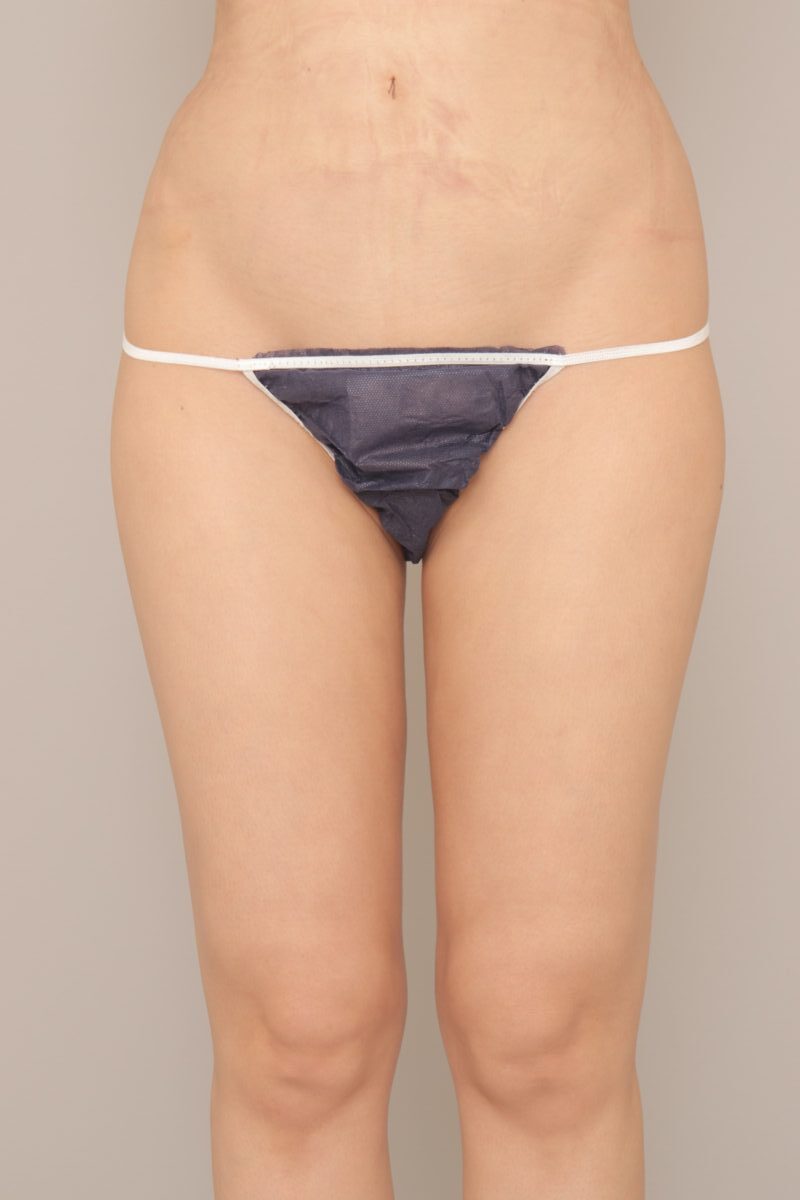 ベイザー脂肪吸引（2か月経過：38）の術後写真