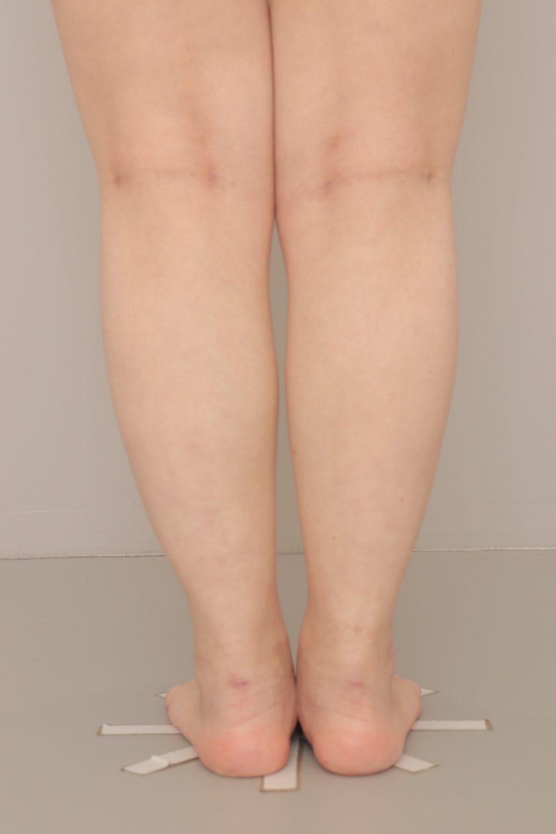 ベイザー脂肪吸引（3か月経過：20）の術後写真