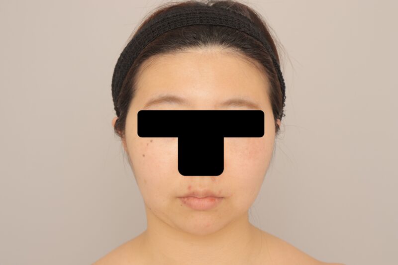 お顔の脂肪吸引は大変人気です