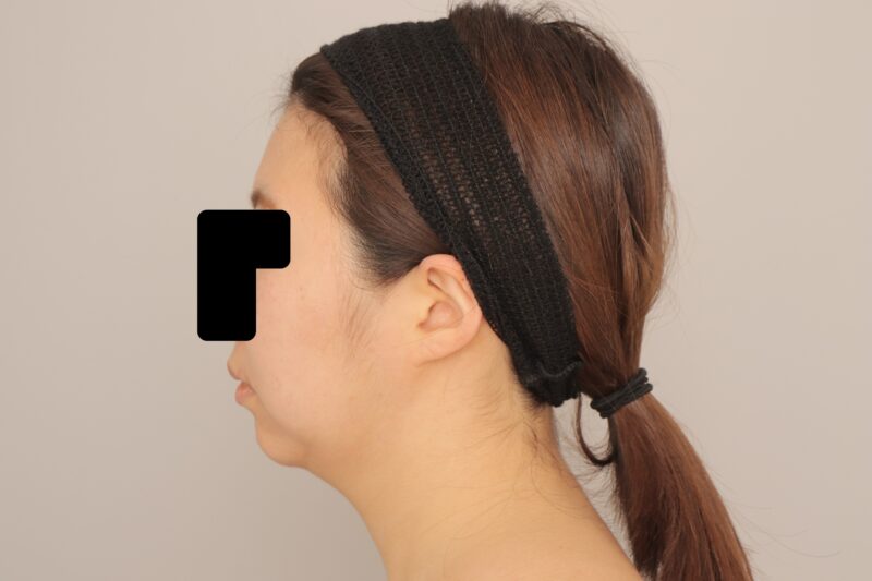 ベイザー脂肪吸引(6か月経過:29)の術後写真