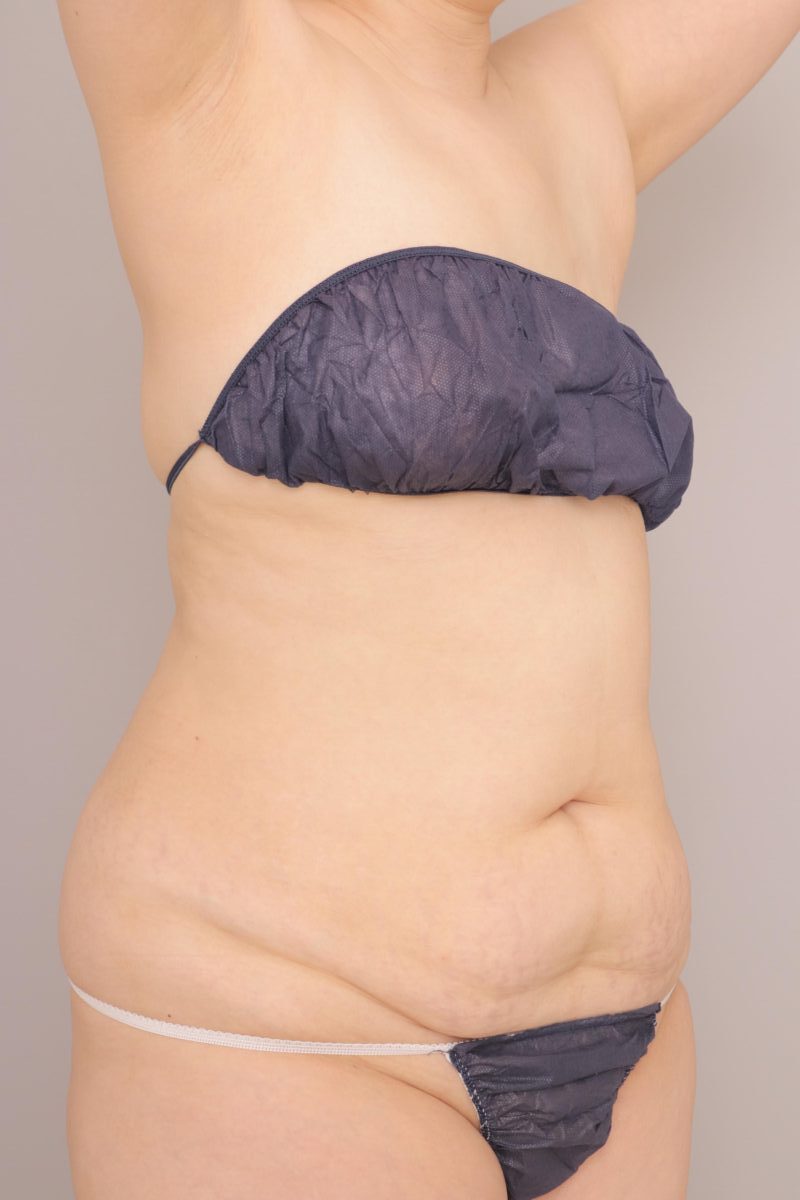 ベイザー脂肪吸引（術後3ヶ月経過：50）の術前写真