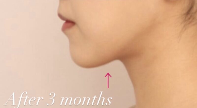 【頬＋顎下】元々小顔の方もより理想のフェイスラインに