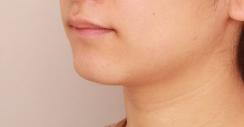 【頬＋顎下】ベイザー併用脂肪吸引でよりスッキリとしたフェイスラインに