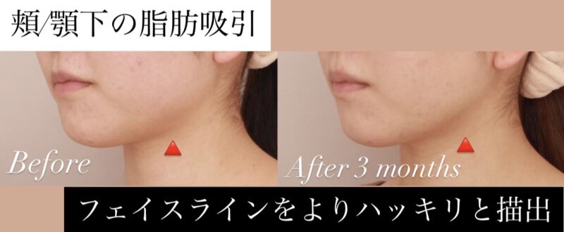 【頬＋顎下】フェイスラインをよりハッキリと描出します！