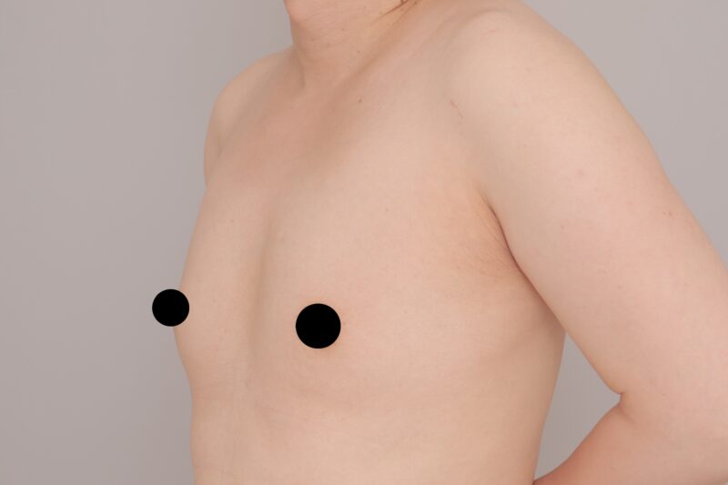 ベイザー脂肪吸引（1ヶ月経過：40）の術前写真