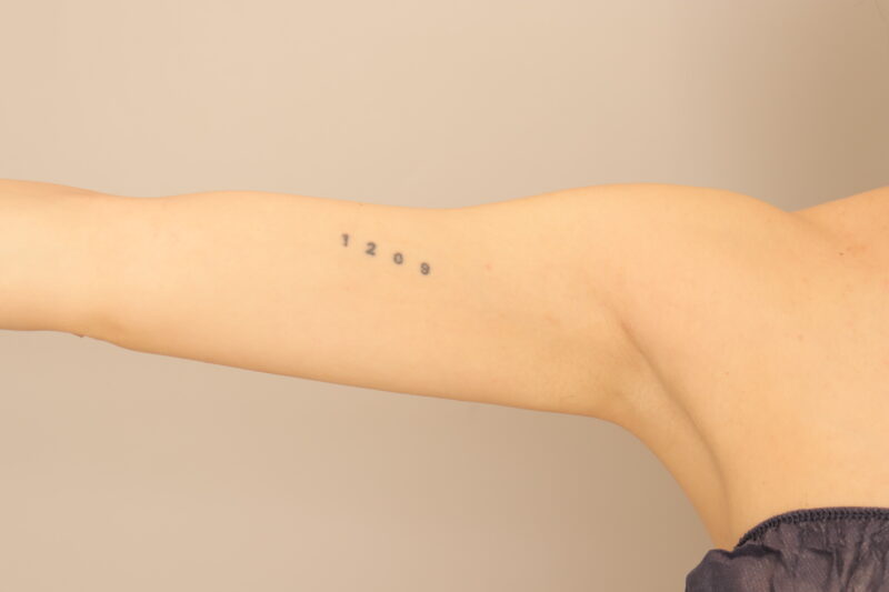 ベイザー脂肪吸引（半年経過：29）の術後写真