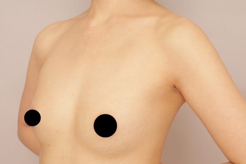 CRF豊胸の１か月経過のご紹介です。