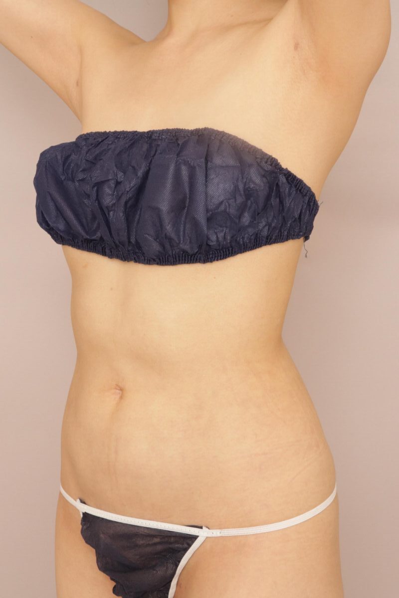 BMI17の方のお腹の脂肪吸引、１か月経過のご紹介です。