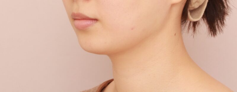 【頬＋顎下】フェイスラインの上下を吸引することでより希望のシルエットに近づけられます