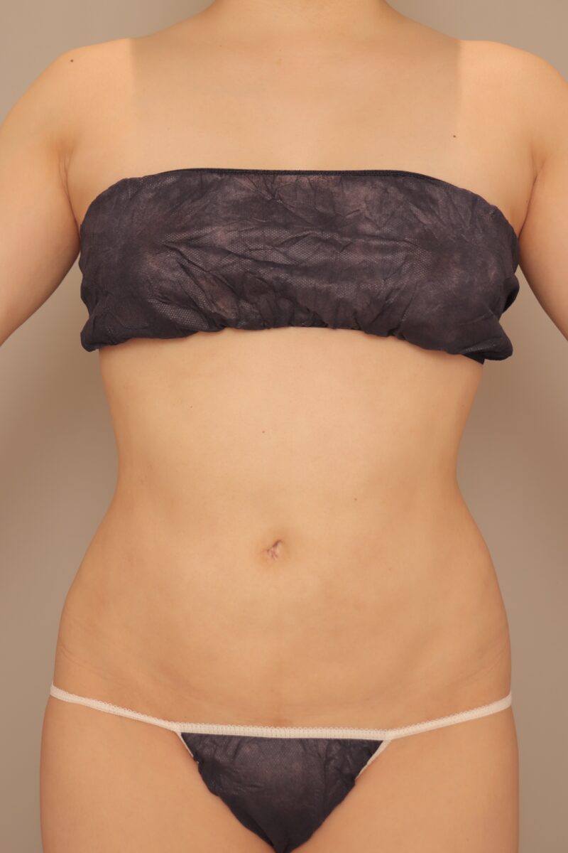 ベイザー脂肪吸引(半年後経過:37)の術後写真