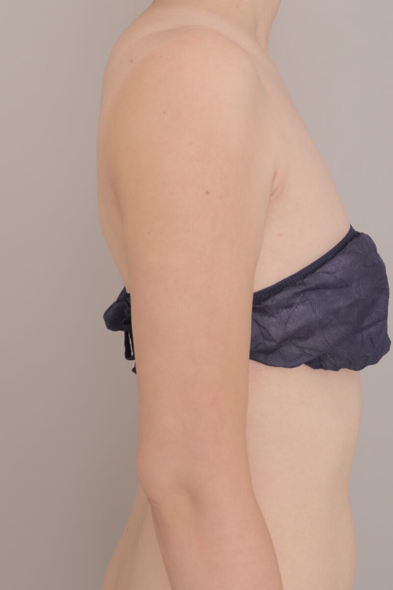 ベイザー脂肪吸引(2ヶ月経過:35)の術後写真