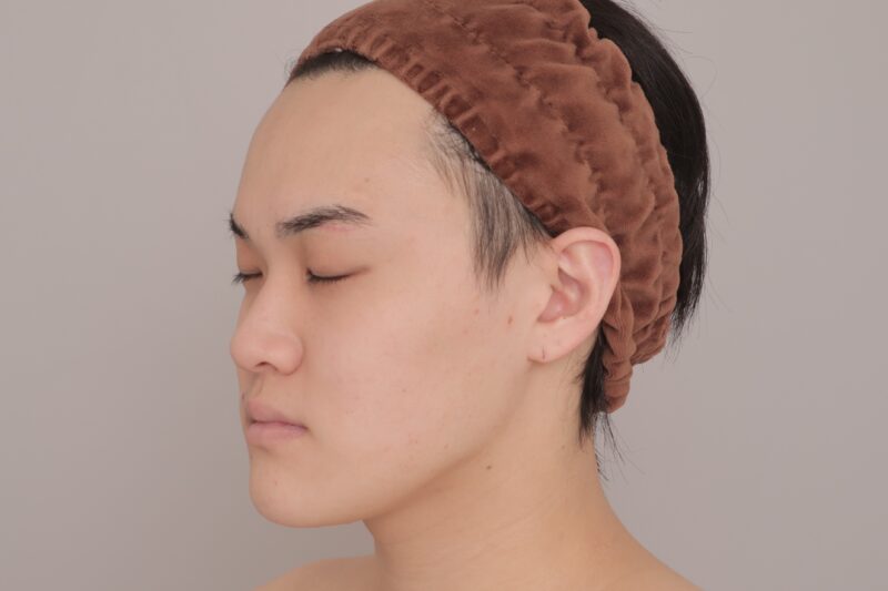 男も顔の脂肪吸引をする時代です！●