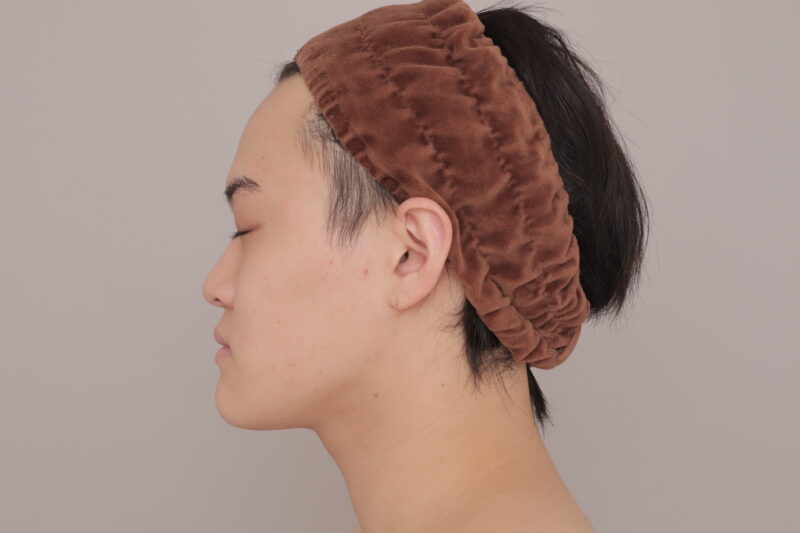 ベイザー脂肪吸引（3ヶ月経過：23）の術後写真