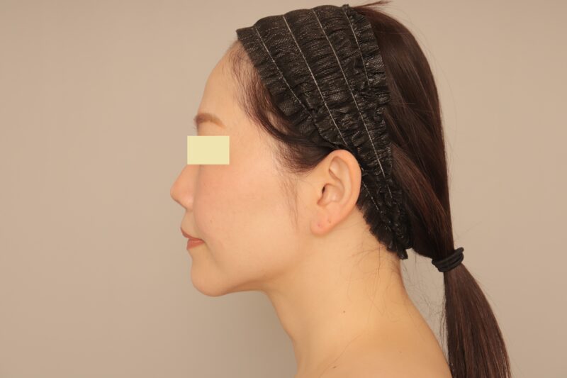 ★２０代の頃のフェイスラインを取り戻せた