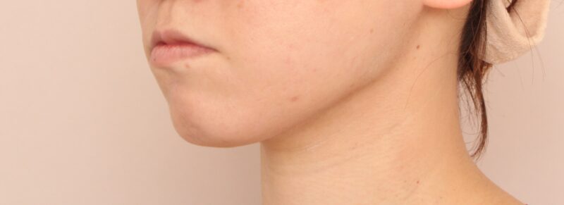 【頬+顎下】よりフェイスラインをくっきりさせるには?