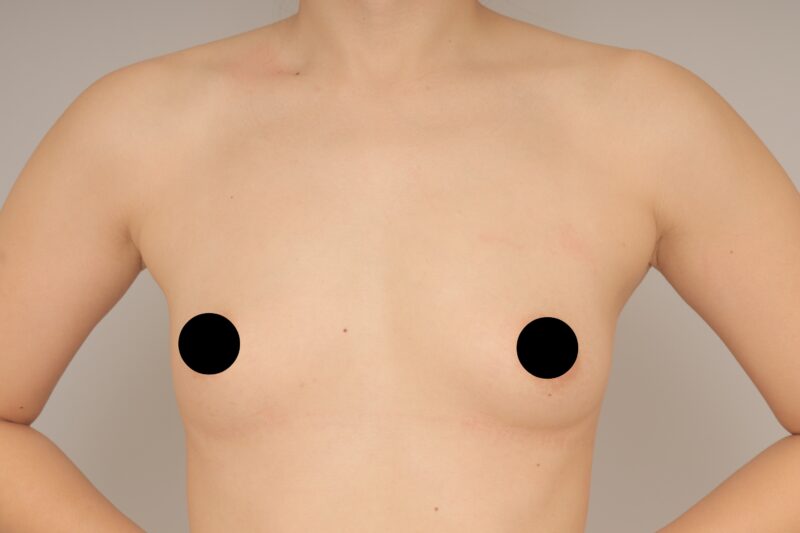 ベイザー脂肪吸引（3か月経過：38）の術前写真