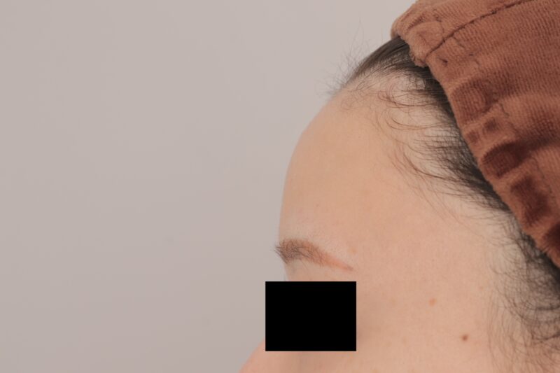 平らおでこ卒業！脂肪注入で“たまご型フェイス”に変身（完成）●