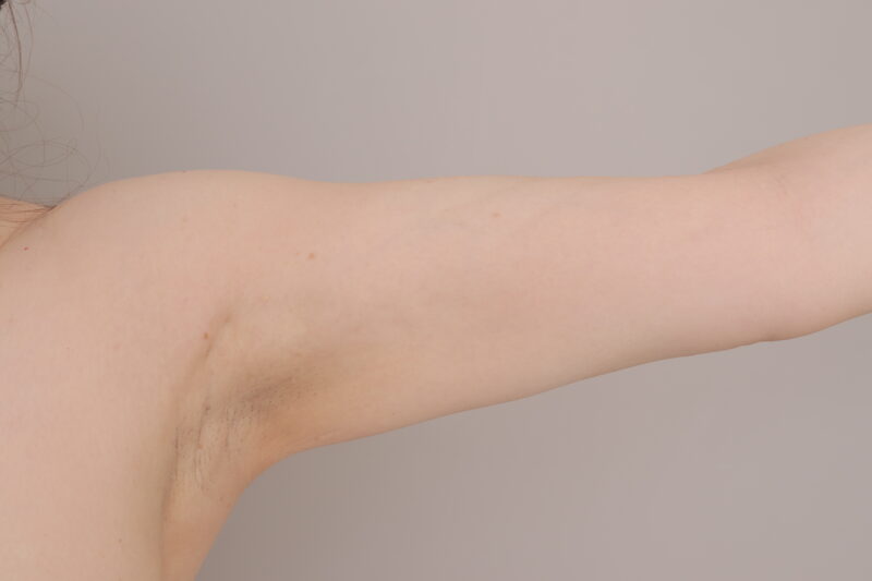 ベイザー脂肪吸引（６か月後経過：53）の術後写真