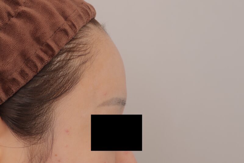 ベイザー脂肪吸引（３か月後経過：35）の術後写真