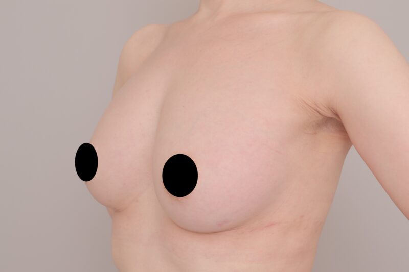 ベイザー脂肪吸引（６か月後経過：38）の術後写真