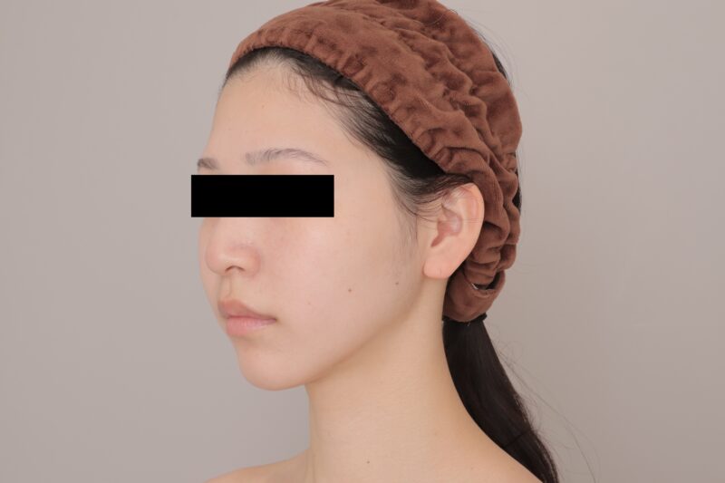 ベイザー脂肪吸引（6ヶ月経過：24）の術後写真