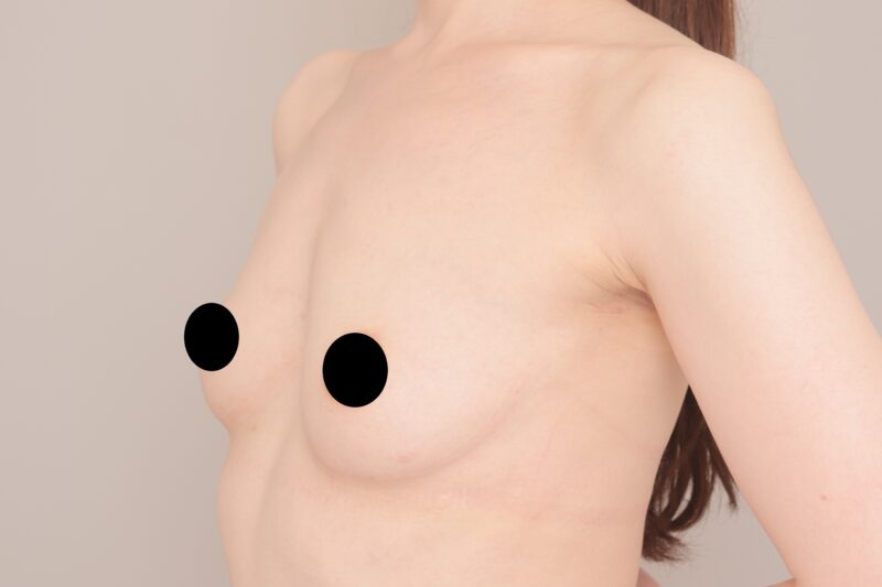 ベイザー脂肪吸引（６か月後経過：38）の術前写真