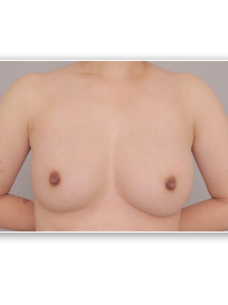 美しく、大きく出来ます。形までこだわるこだわる〝美〟豊胸~35歳160cm53kg脂肪豊胸(CRFバスト)2次豊胸後3か月~