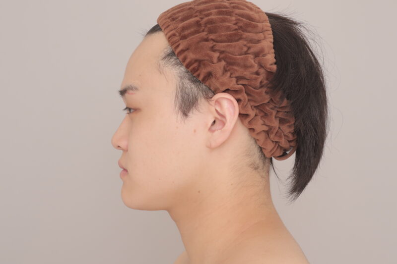 ベイザー脂肪吸引（3ヶ月経過：23）の術前写真