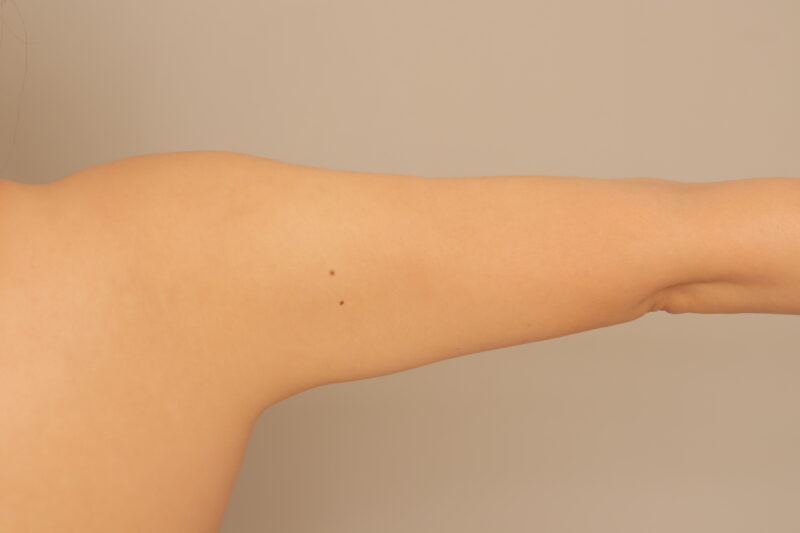 ベイザー脂肪吸引（半年経過：31）の術後写真