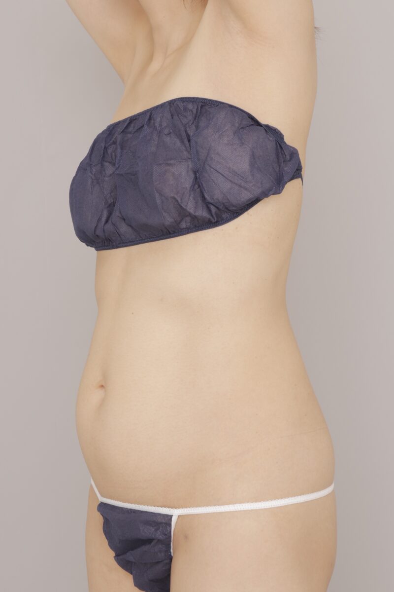 ベイザー脂肪吸引（3ヶ月経過：38）の術前写真