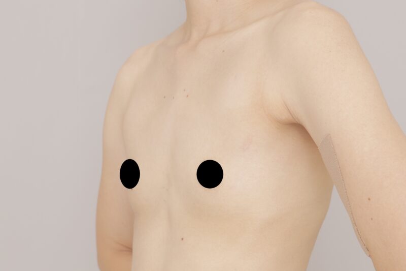 ベイザー脂肪吸引（1か月後経過：36）の術前写真