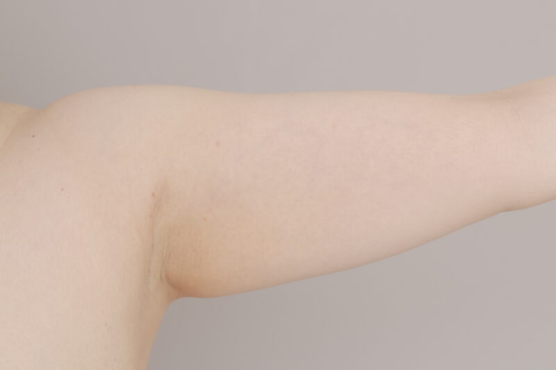 ベイザー脂肪吸引（６か月後経過：53）の術前写真