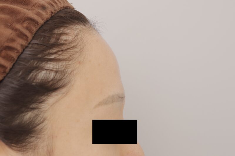 ベイザー脂肪吸引（３か月後経過：35）の術前写真