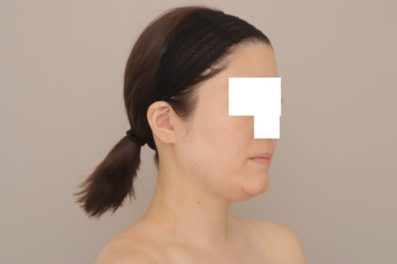 ベイザー脂肪吸引（3ヶ月経過：34）の術前写真