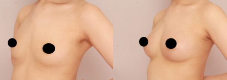 【脂肪豊胸】自然でばれにくい豊胸をご希望の方、ぜひご相談ください!