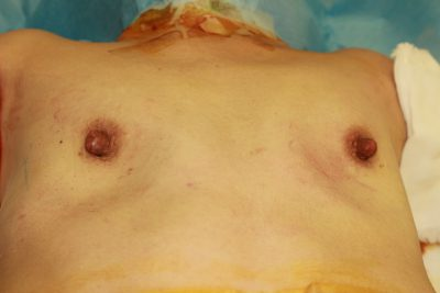 凹んでしまった胸をコンデンスリッチ豊胸で綺麗に・・・