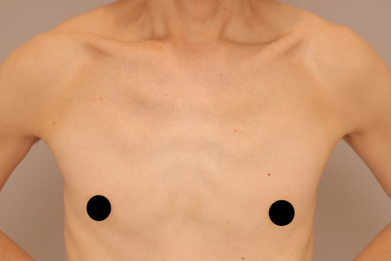 ベイザー脂肪吸引（13ヶ月後経過：50）の術前写真