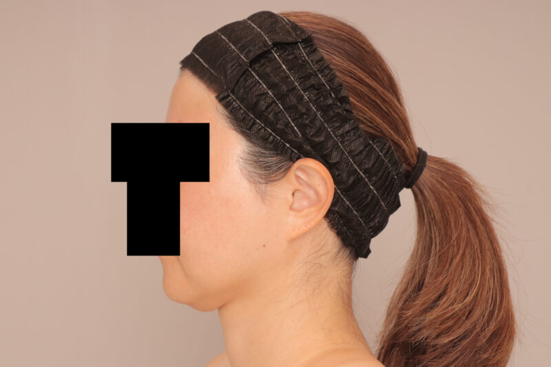 ベイザー脂肪吸引（半年後経過：41）の術前写真