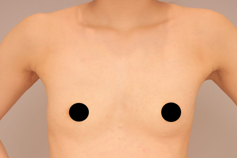 ベイザー脂肪吸引（8ヶ月後経過：35）の術前写真