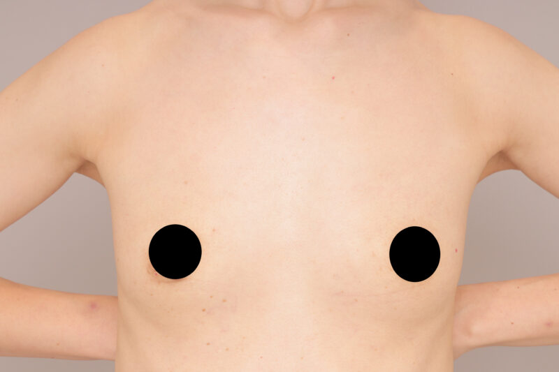 ベイザー脂肪吸引（半年後経過：39）の術前写真